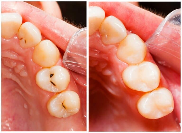 Composite-Tooth-Colored-Fillings