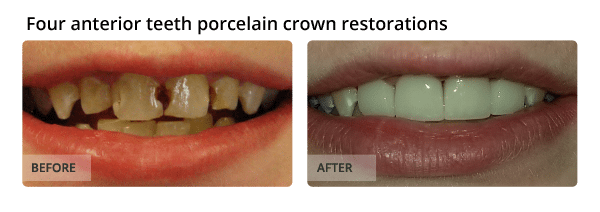 Four anterior teeth porcelain crown restorations