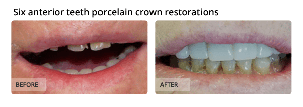 Six anterior teeth porcelain crown restorations
