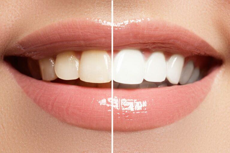 Teeth Whitening Service