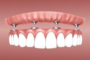 Tips To Mentally Prepare Yourself for Complete Dental Implants