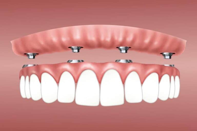 Tips To Mentally Prepare Yourself for Complete Dental Implants