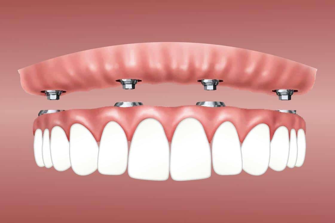 Tips To Mentally Prepare Yourself for Complete Dental Implants