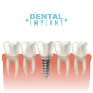 5-health-related-benefits-of-full-mouth-implants