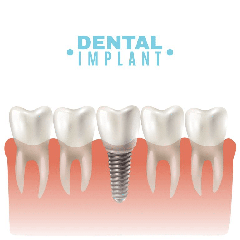 5 Health-Related Benefits of Full-mouth Implants